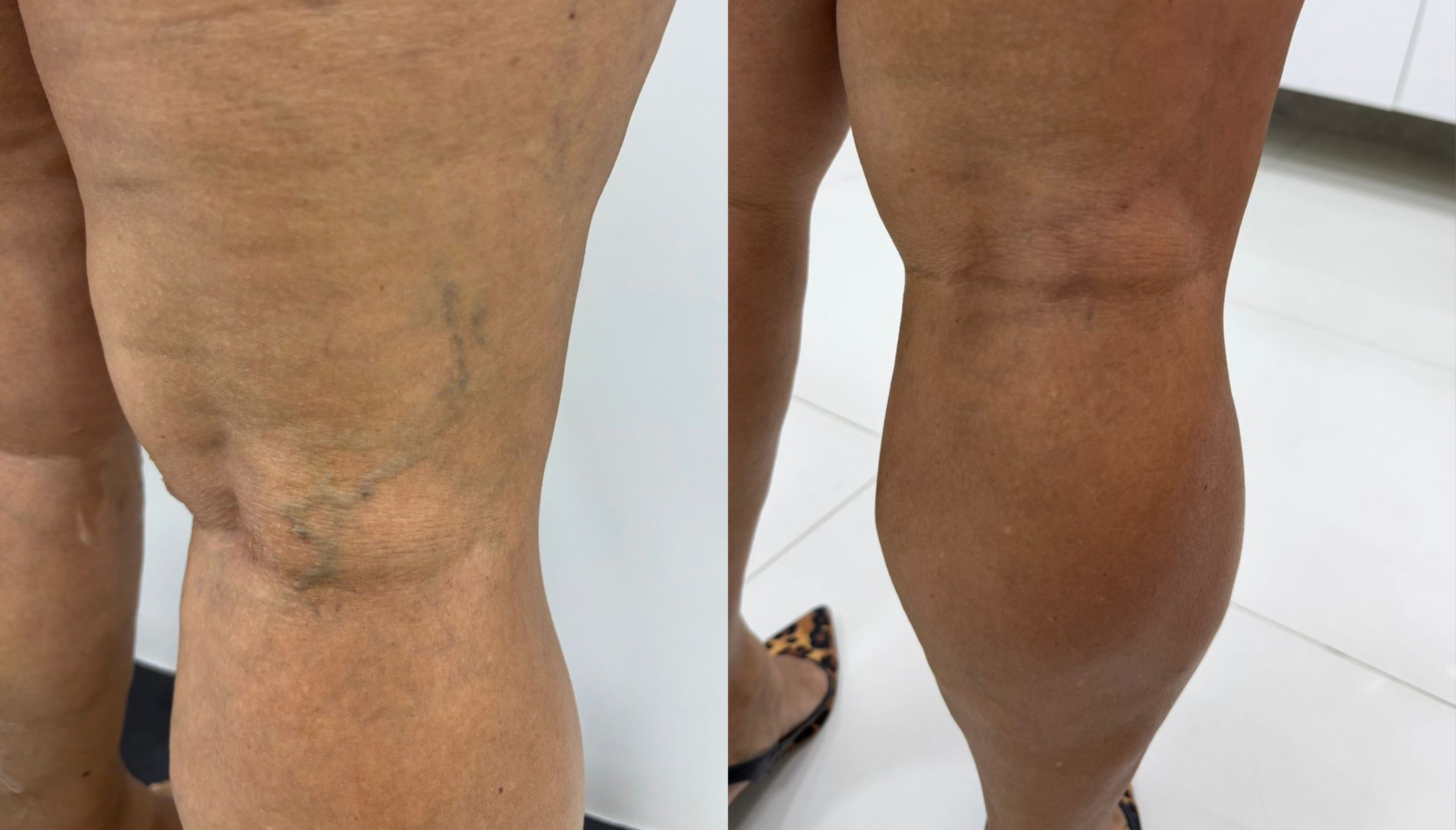 Caso 04 — Antes e Depois